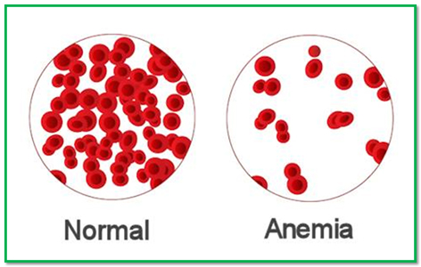 anemia